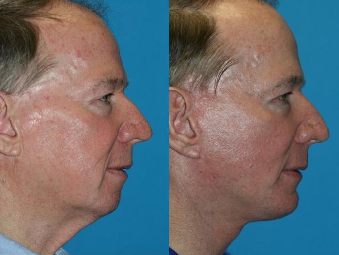 Before & After Facelift Case 55 Right Side View in Charleston, SC