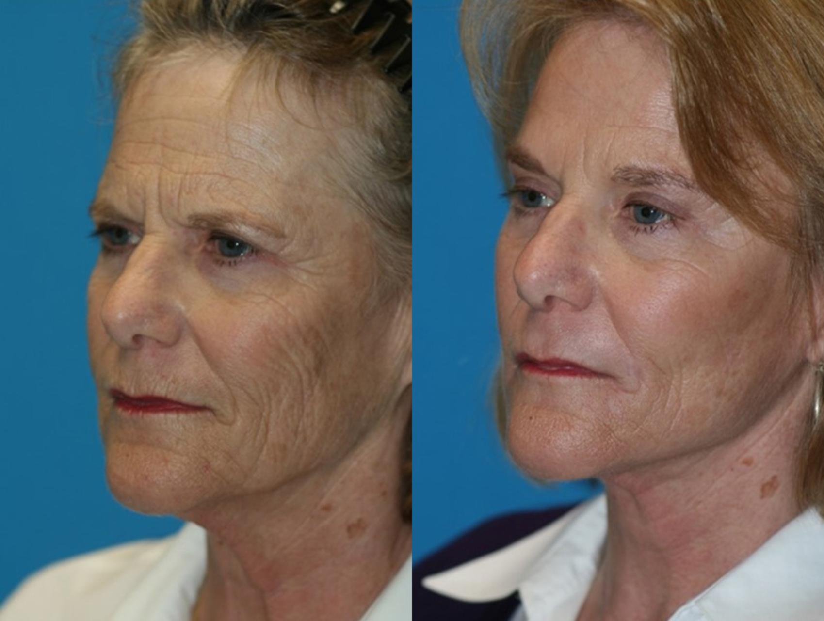Before & After Facelift Case 56 Left Oblique View in Charleston, SC