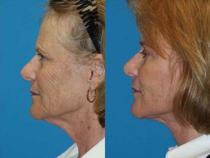 Before & After Facelift Case 56 Left Side View in Charleston, SC