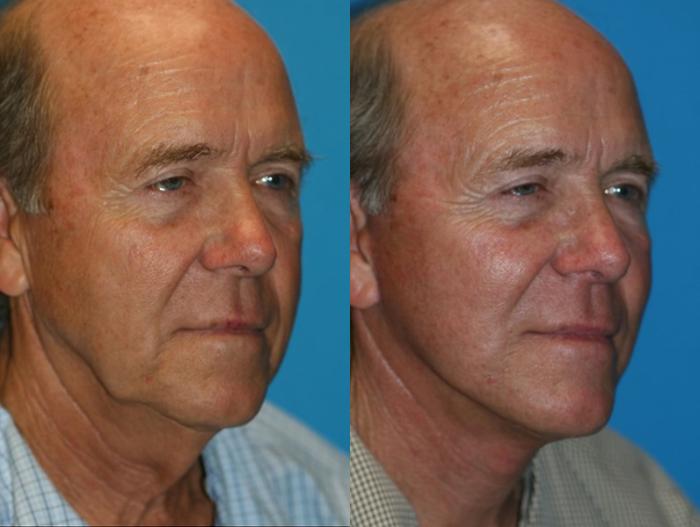 Before & After Facelift Case 57 Right Oblique View in Charleston, SC