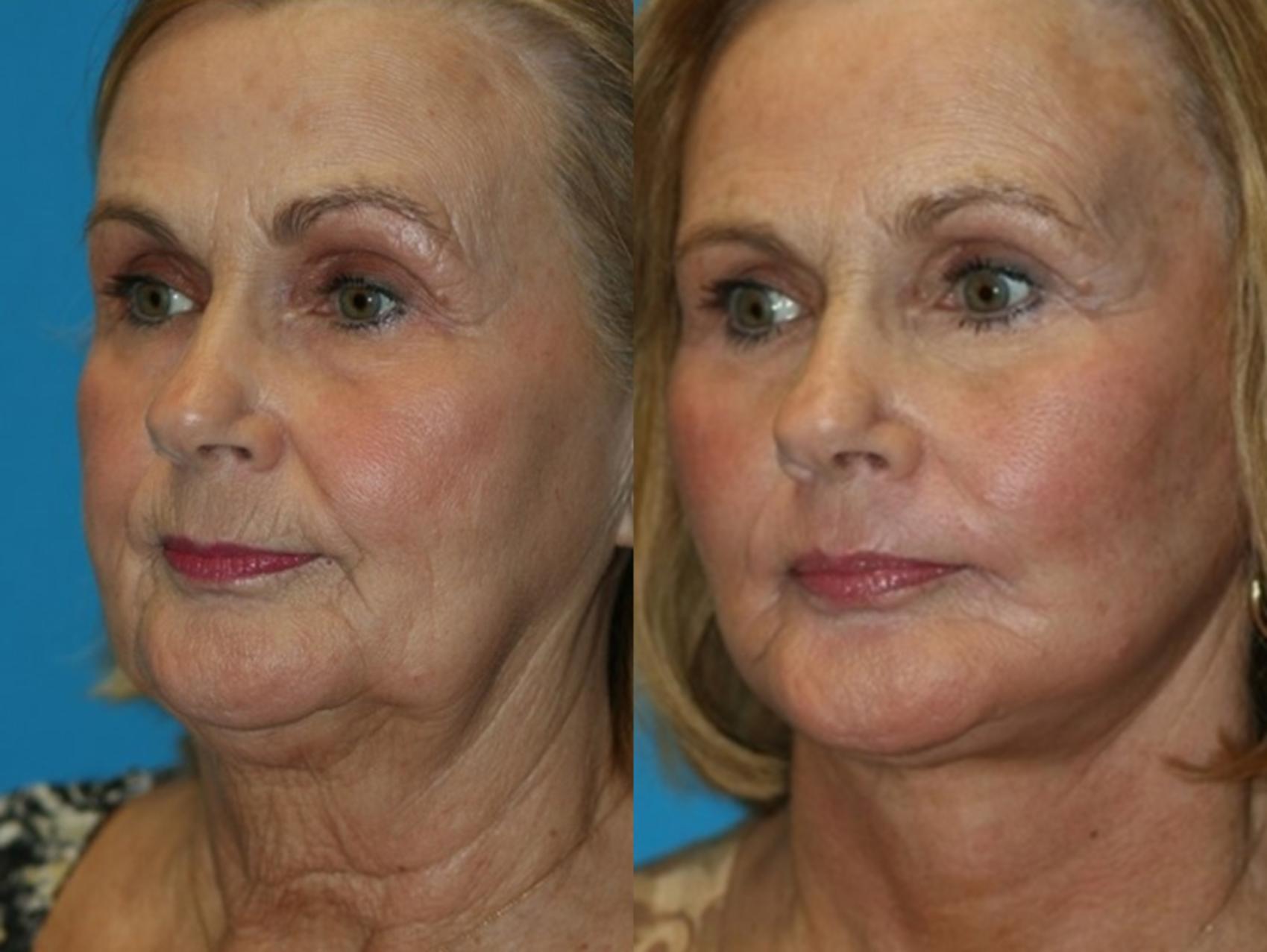 Before & After Facelift Case 58 Left Oblique View in Charleston, SC
