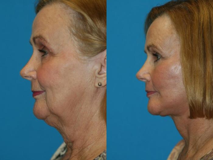 Before & After Facelift Case 58 Left Side View in Charleston, SC