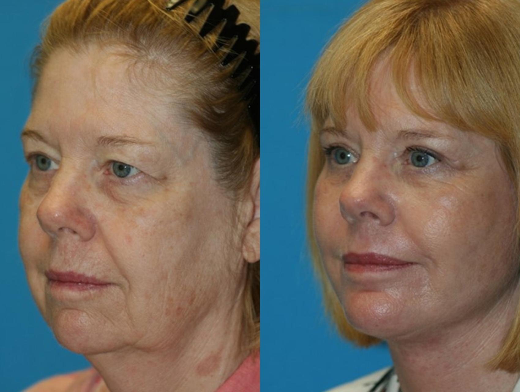 Before & After Facelift Case 59 Left Oblique View in Charleston, SC