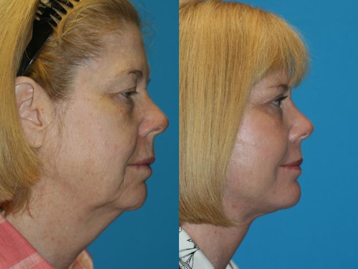 Before & After Facelift Case 59 Right Side View in Charleston, SC