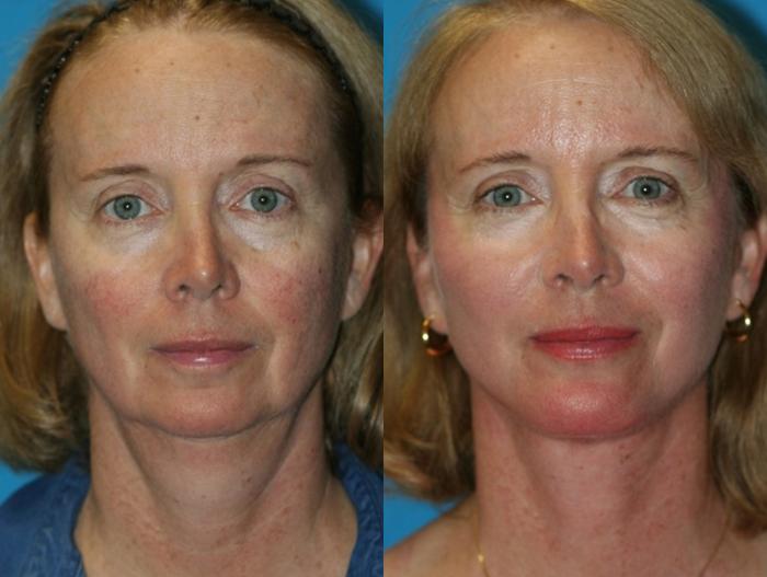 Before & After Facelift Case 60 Front View in Charleston, SC