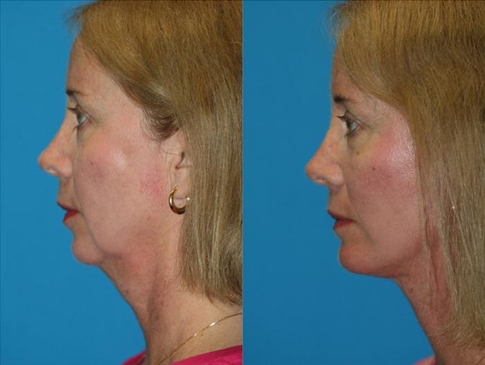 Before & After Facelift Case 60 Left Side View in Charleston, SC