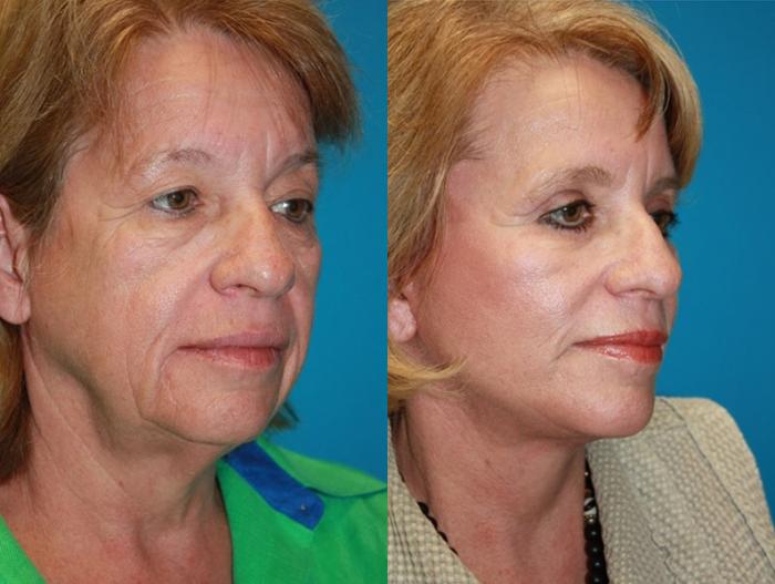 Before & After Facelift Case 61 Right Oblique View in Charleston, SC