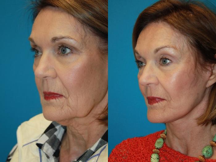 Before & After Facelift Case 62 Left Oblique View in Charleston, SC