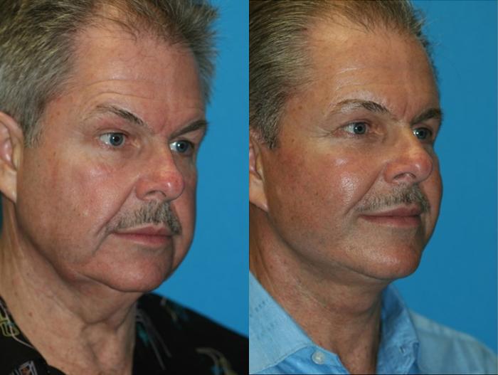 Before & After Facelift Case 63 Right Oblique View in Charleston, SC