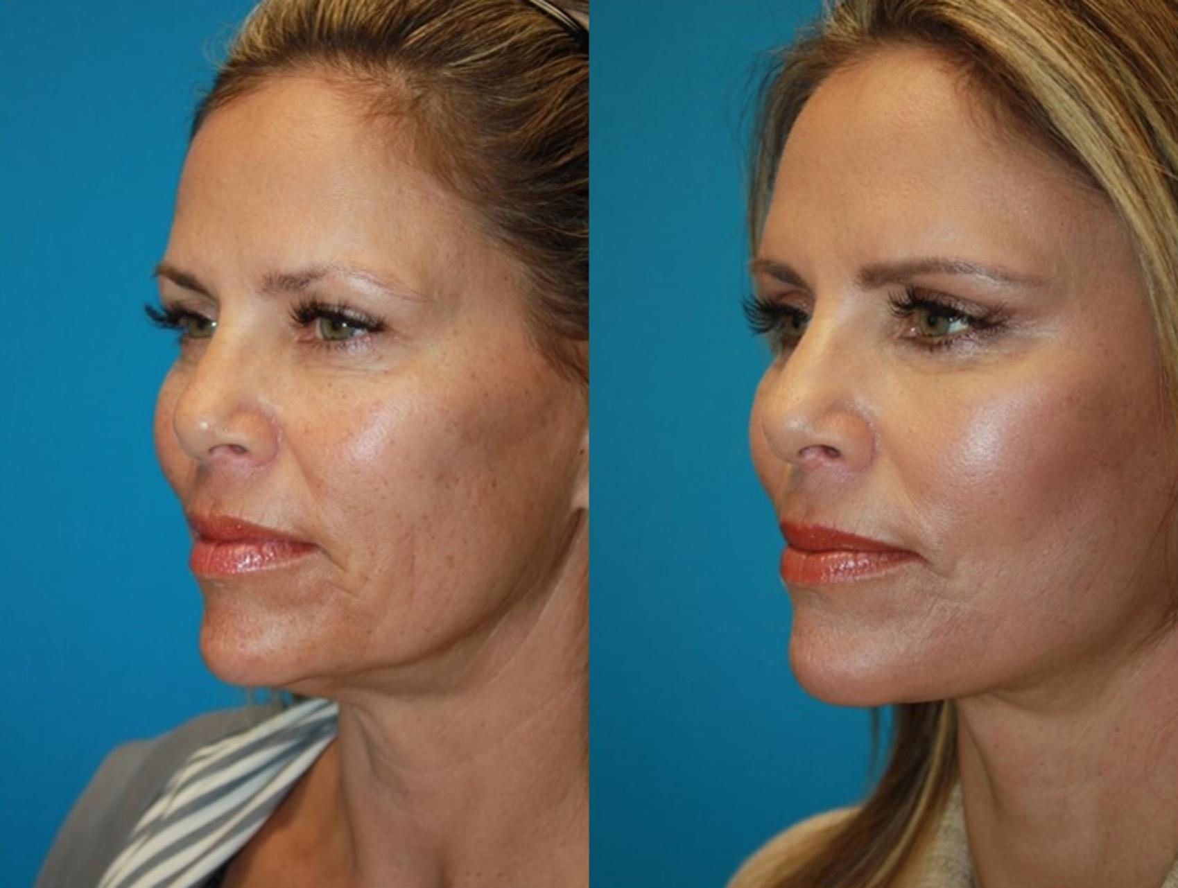 Before & After Facelift Case 64 Left Oblique View in Charleston, SC
