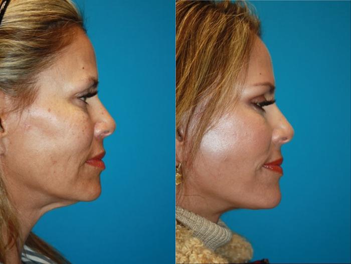 Before & After Facelift Case 64 Right Side View in Charleston, SC