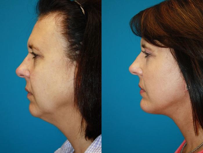 Before & After Facelift Case 65 Left Side View in Charleston, SC