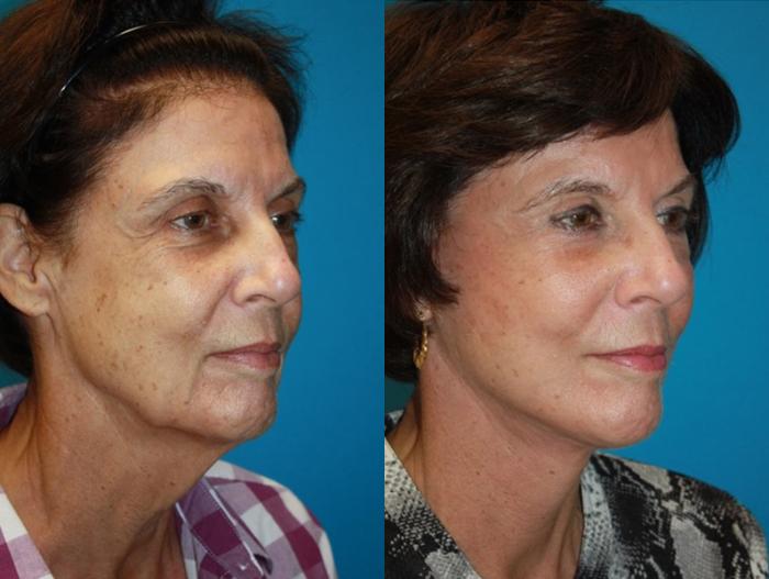 Before & After Facelift Case 66 Left Oblique View in Charleston, SC