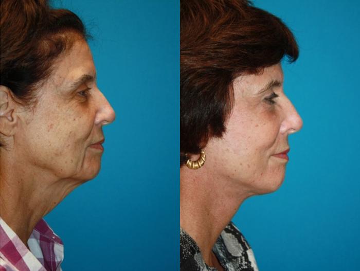 Before & After Facelift Case 66 Right Side View in Charleston, SC