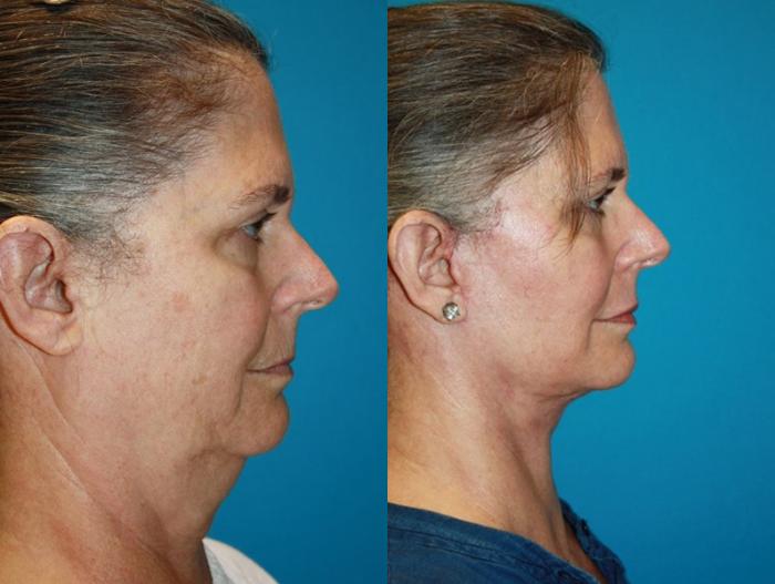 Before & After Facelift Case 67 Right Side View in Charleston, SC