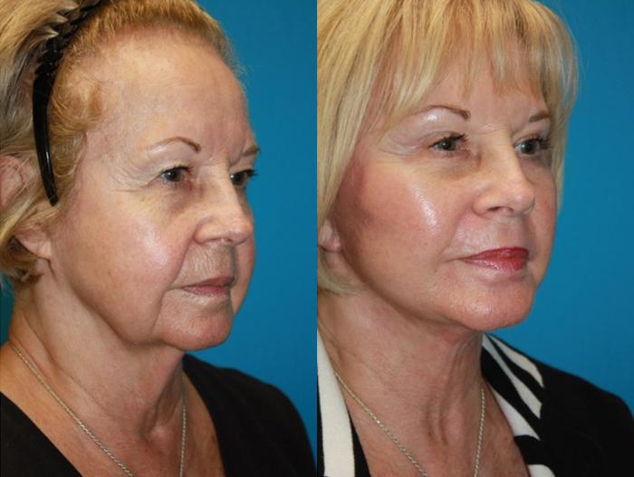 Before & After Facelift Case 68 Right Oblique View in Charleston, SC