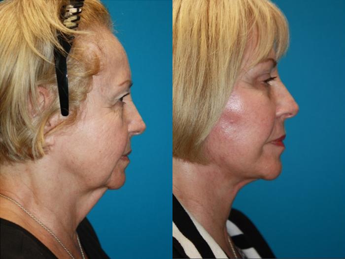 Before & After Facelift Case 68 Right Side View in Charleston, SC