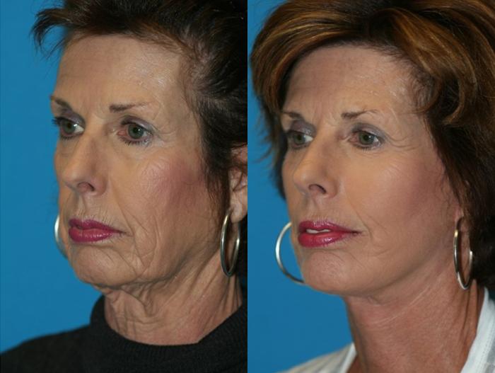 Before & After Facelift Case 69 Left Oblique View in Charleston, SC