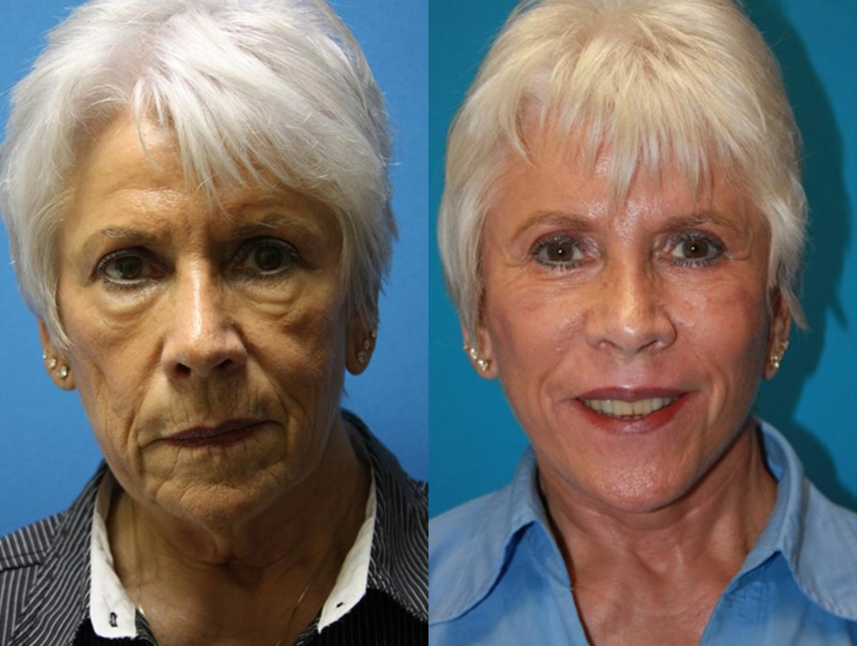 Facelift Before And After Pictures Case 70 Charleston SC Crantford 
