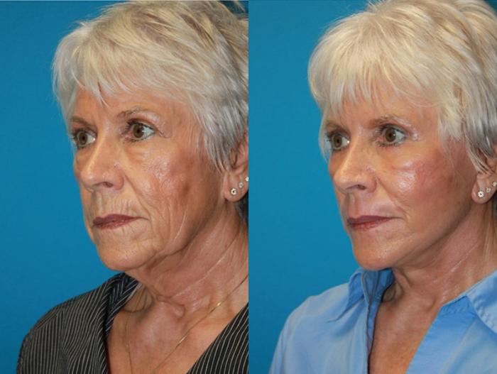Before & After Facelift Case 70 Left Oblique View in Charleston, SC