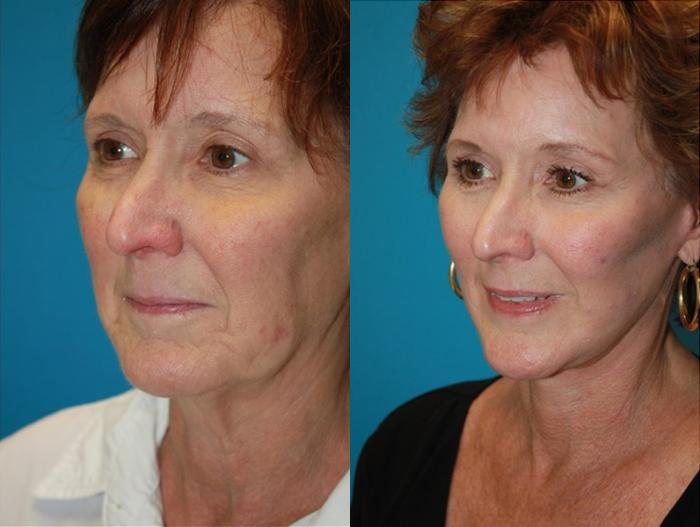 Before & After Facelift Case 71 Left Oblique View in Charleston, SC