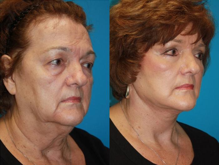 Before & After Facelift Case 72 Right Oblique View in Charleston, SC