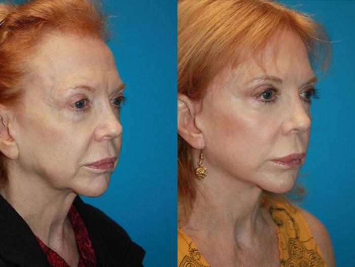 Before & After Facelift Case 73 Right Oblique View in Charleston, SC