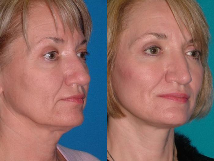 Before & After Facelift Case 75 Right Oblique View in Charleston, SC