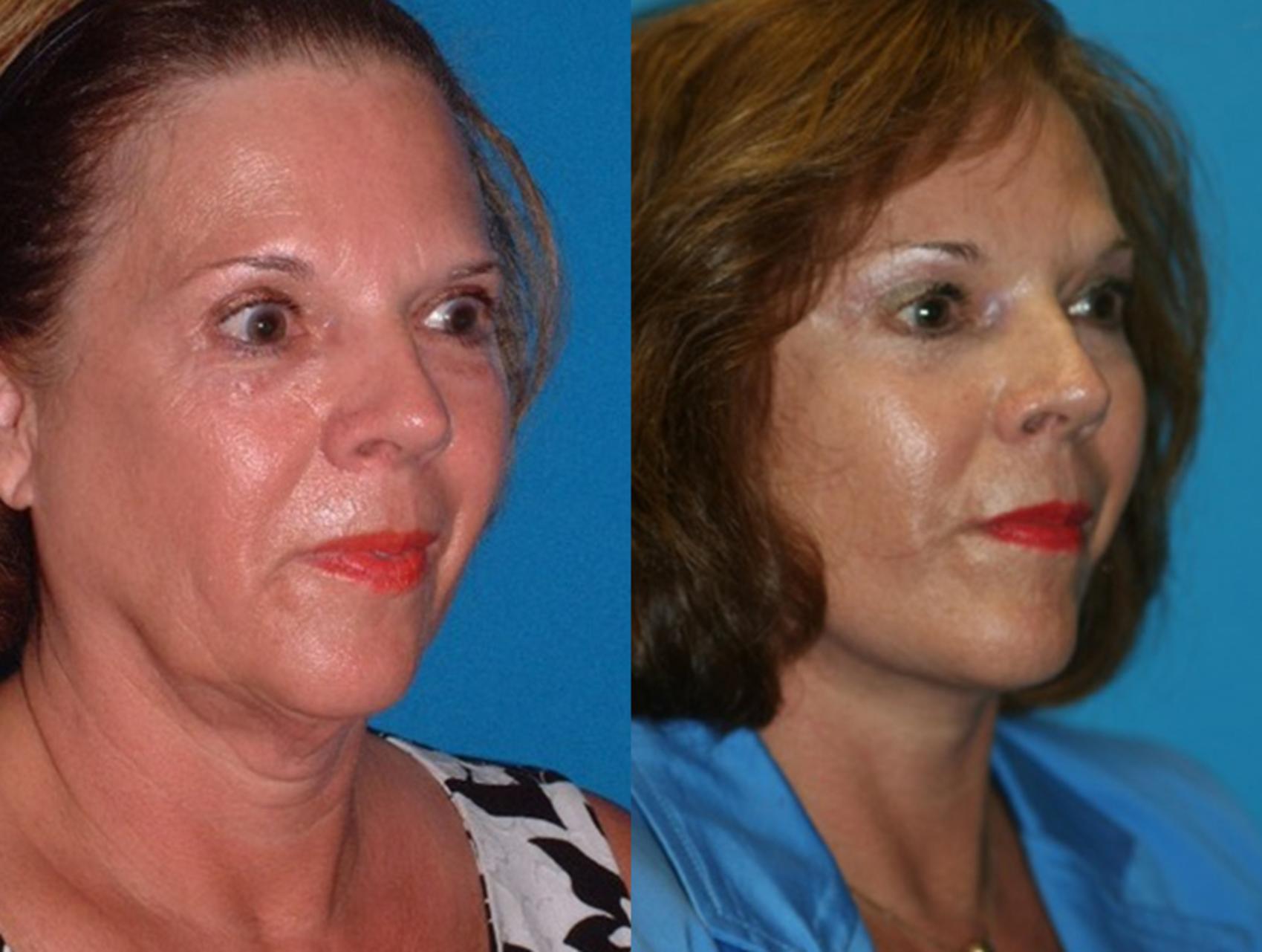 Before & After Facelift Case 76 Right Oblique View in Charleston, SC