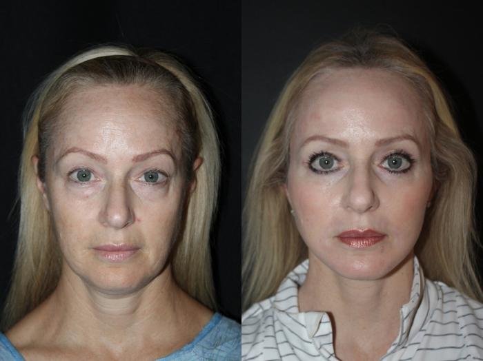 Before & After Laser Skin Resurfacing Case 89 Front View in Charleston, SC
