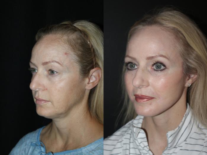 Before & After Blepharoplasty Case 89 Left Oblique View in Charleston, SC