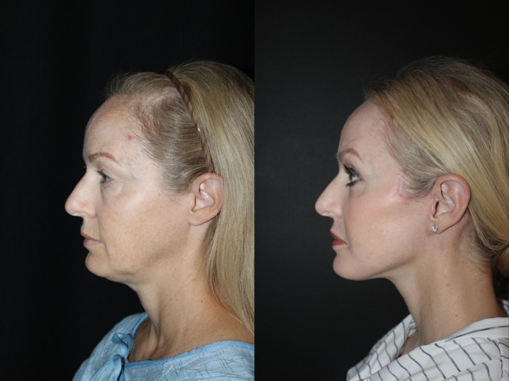 Before & After Laser Skin Resurfacing Case 89 Left Side View in Charleston, SC