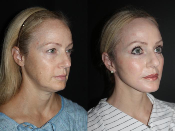 Before & After Blepharoplasty Case 89 Right Oblique View in Charleston, SC