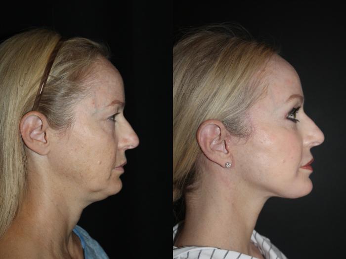 Before & After Neck Lift Case 89 Right Side View in Charleston, SC