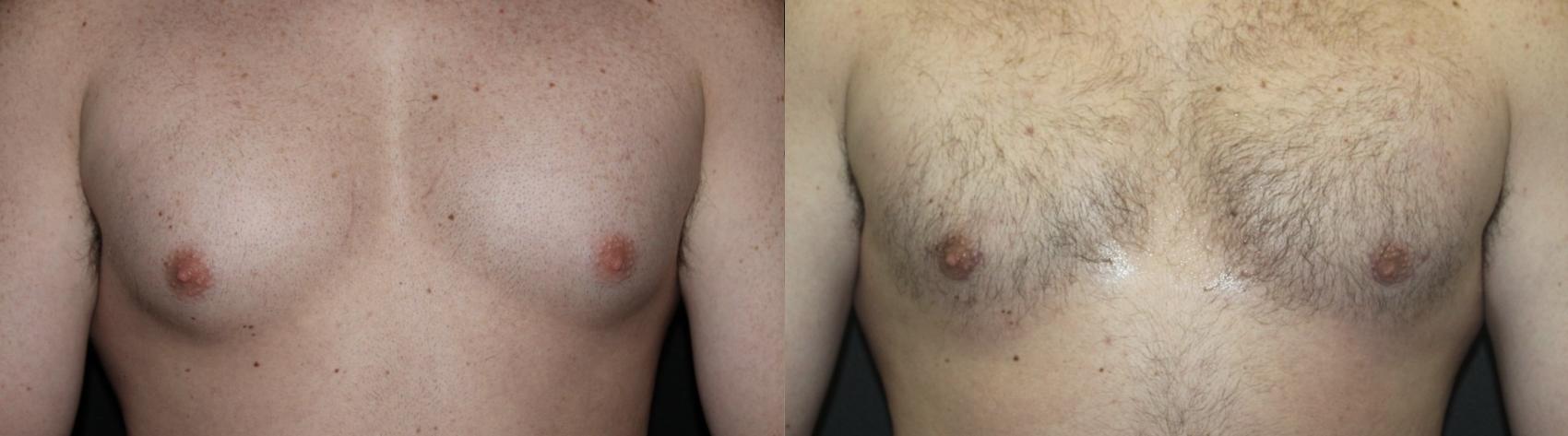 Before & After Gynecomastia Surgery Case 113 Front View in Charleston, SC