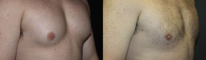Before & After Gynecomastia Surgery Case 113 Right Oblique View in Charleston, SC