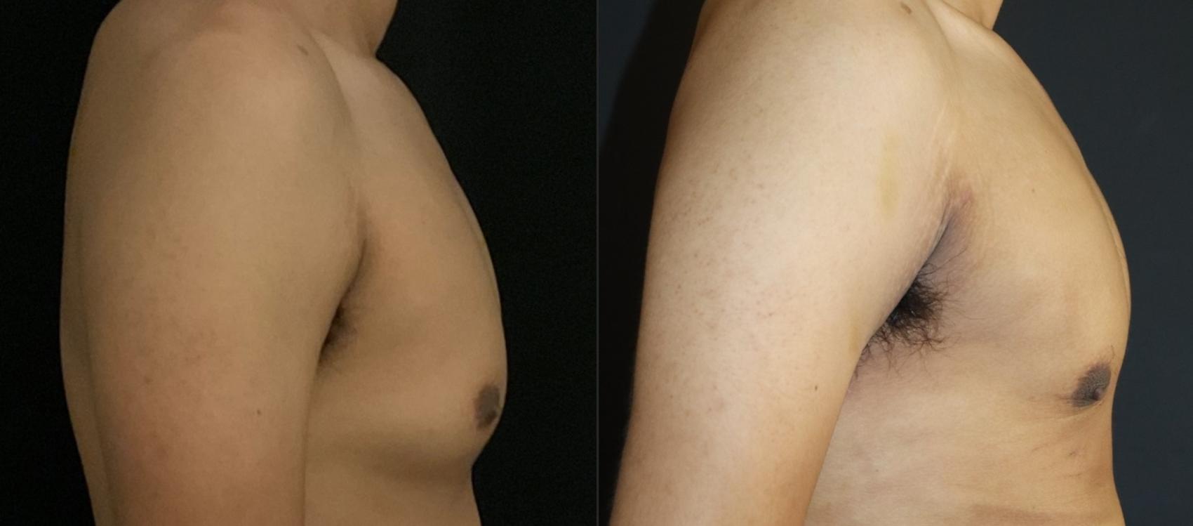 Before & After Gynecomastia Surgery Case 114 Right Side View in Charleston, SC