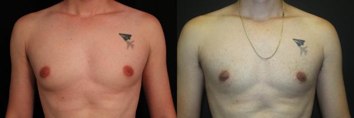 Before & After Gynecomastia Surgery Case 91 Front View in Charleston, SC