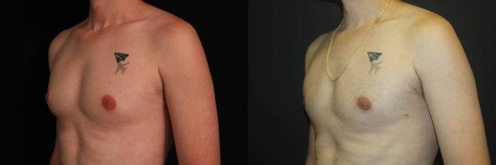Before & After Gynecomastia Surgery Case 91 Left Oblique View in Charleston, SC