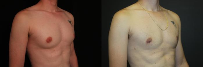 Before & After Gynecomastia Surgery Case 91 Right Oblique View in Charleston, SC