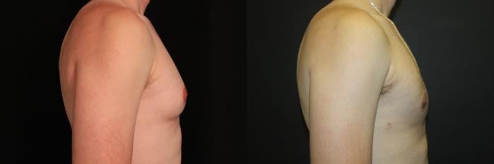 Before & After Gynecomastia Surgery Case 91 Right Side View in Charleston, SC