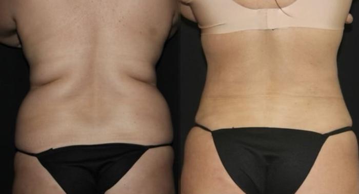 Before & After Liposuction Case 115 Back View in Charleston, SC
