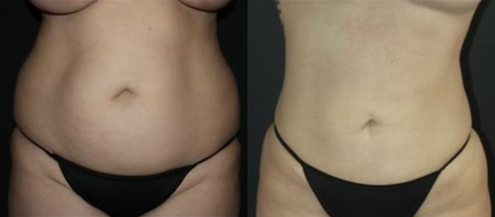 Before & After Liposuction Case 115 Front View in Charleston, SC