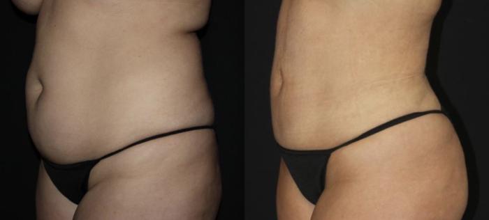 Before & After Liposuction Case 115 Left Oblique View in Charleston, SC