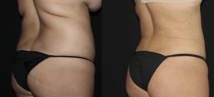 Before & After Liposuction Case 115 Right Oblique View in Charleston, SC