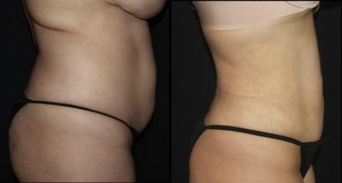 Before & After Liposuction Case 115 Right Side View in Charleston, SC