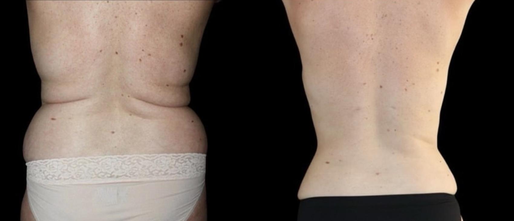 Before & After Liposuction Case 116 Back View in Charleston, SC