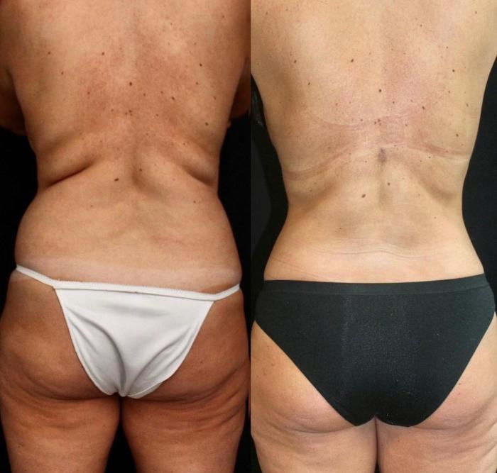 Before & After Liposuction Case 124 Back View in Charleston, SC