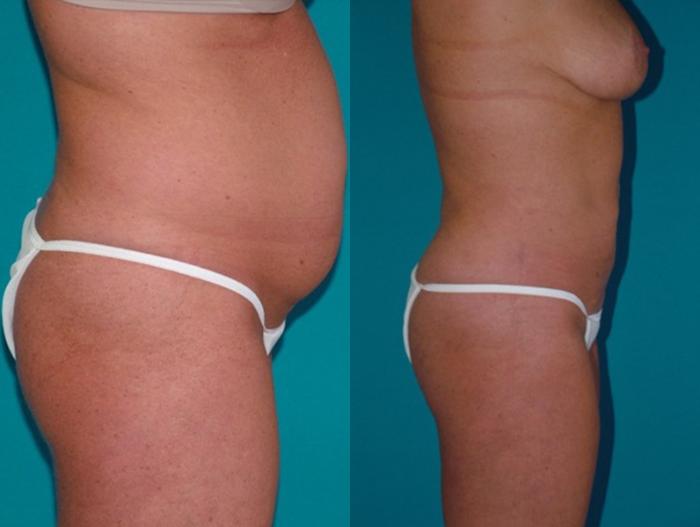 Before & After Liposuction Case 3 Right Side View in Charleston, SC