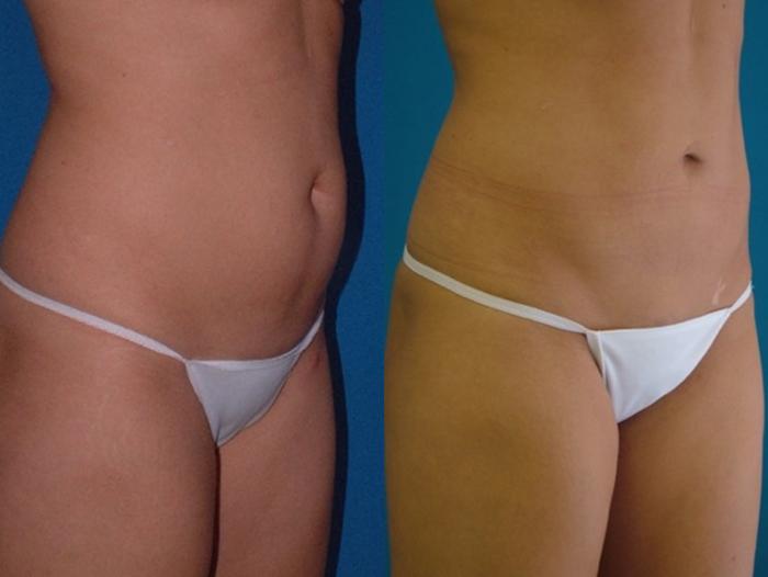 Before & After Liposuction Case 4 Right Oblique View in Charleston, SC